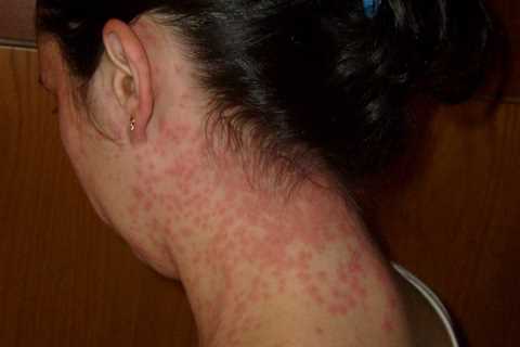 Stress Rash – Treatment and 6 Prevention Tips