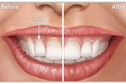 Reverse Receding Gums And How To Stop receding gums From Further Advancement?