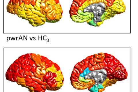 Substantial Differences in Brain Structure in People With Anorexia - Neuroscience News