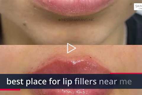 Places to get lip fillers near me