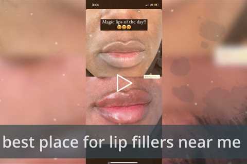 Lip Fillers Los Angeles