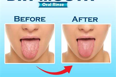 How to Stop Dry Mouth
