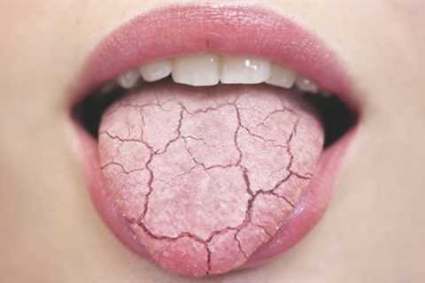 Home Remedy Dry Mouth