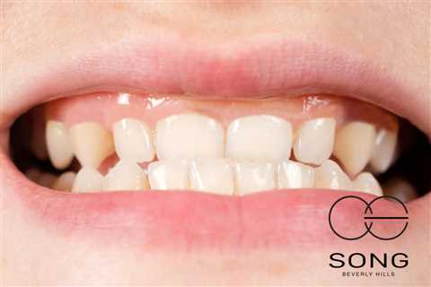 All about Gummy Smile Treatments in Beverly Hills