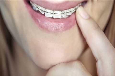 Are cosmetic braces safe?