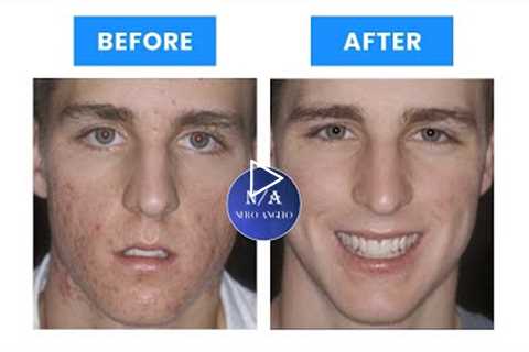 Looksmaxxing Guide : How to get clear skin - (Blackpill Analysis)