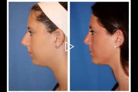 Trends in Facial Plastic Surgery | Dr William Portuese | 206-624-6200