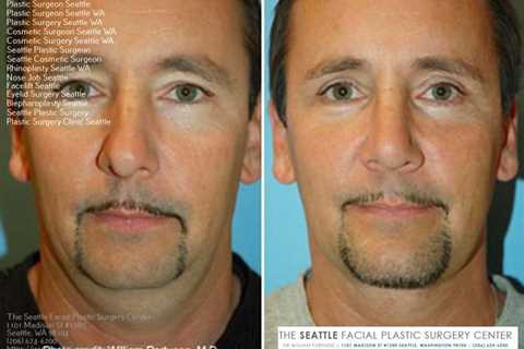 best rhinoplasty surgeon in seattle | Rhinoplasty surgeon, Rhinoplasty, Facial surgery