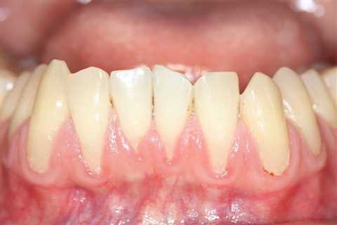 How Can You Reverse Receding Gums?