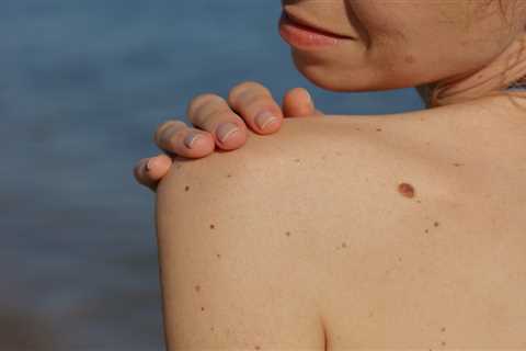 I’m a mole specialist – these are the skin cancer signs I’m looking for