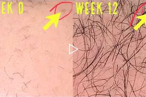 UNBELIEVABLE MICRONEEDLING/DERMA ROLLING RESULTS FOR HAIR GROWTH!
