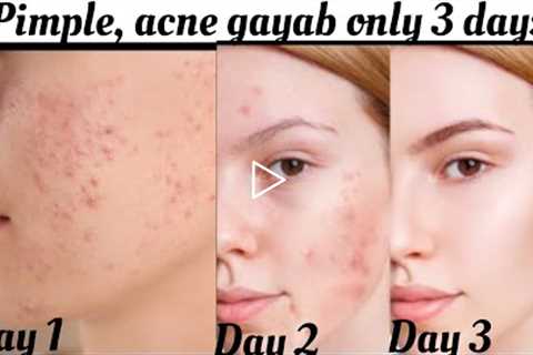 How to remove pimple overnight/3 to 7 days challenge, naturally, acne treatment
