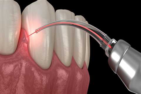 What is laser in dentistry?