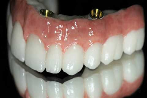 Why are full mouth implants so expensive?