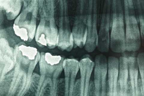 How toxic are dental x-rays?