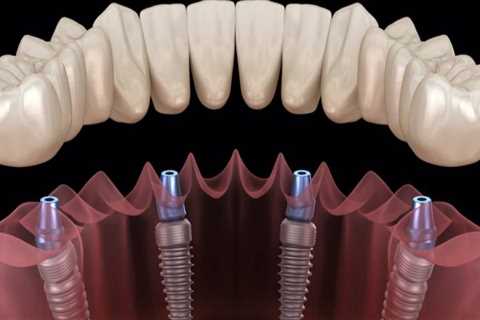 What are the most durable dental implants?