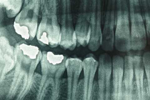 Are frequent dental xrays harmful?
