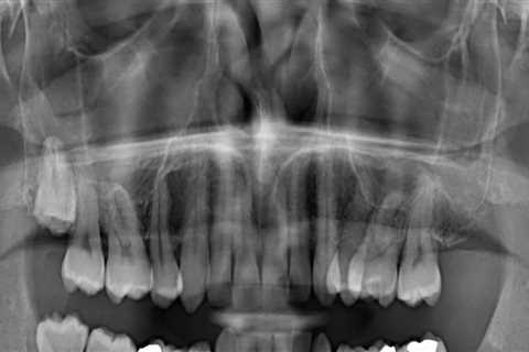 Do dental x-rays have a lot of radiation?