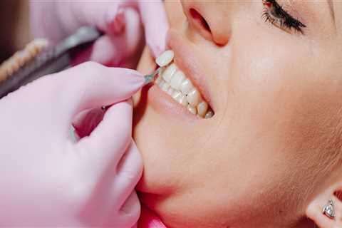 How To Find A London Emergency Dentist To Repair Your Dental Veneers