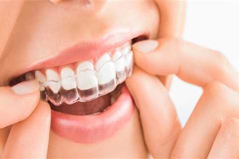 Do clear aligners work faster?