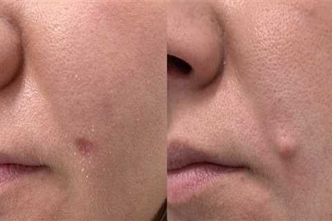Laser Mole Removal Aftercare: Tips and Advice