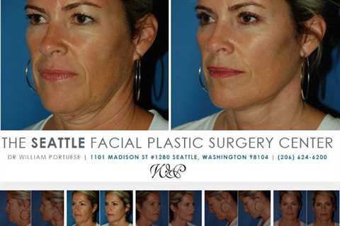 Facelift Surgery Seattle Washington