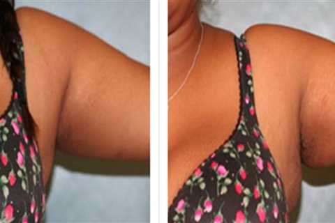What are the after effects of laser lipo?