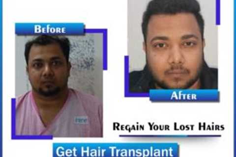 The Facts About Hair Transplant In Indore Uncovered