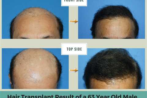 Top Guidelines Of Hair Transplant In Indore