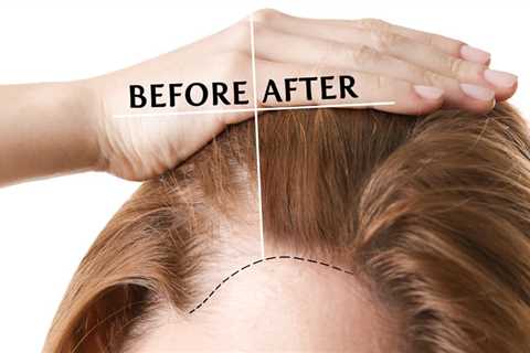 Hair Transplant In Indore Can Be Fun For Anyone