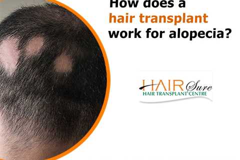 The Main Principles Of Hair Transplant In Indore