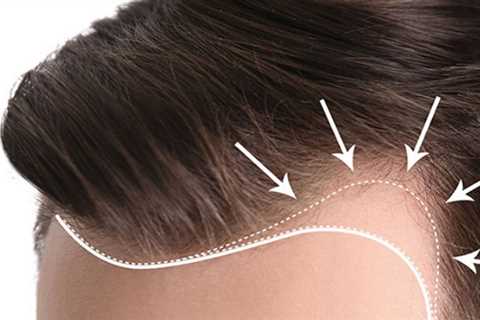 The smart Trick of Hair Transplant In Indore That Nobody is Discussing