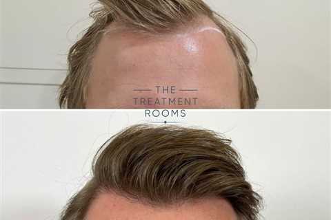 Getting The Hair Transplant In Indore To Work