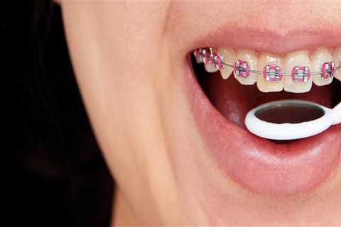 What are the types of orthodontic treatment?