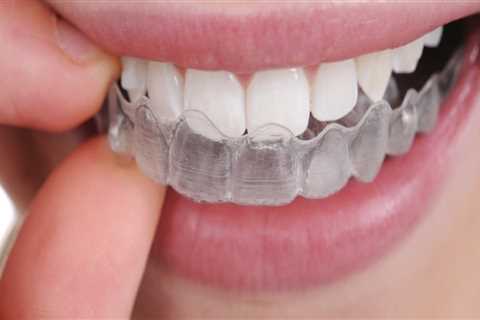 Are Clear Aligners Safe? An Expert's Perspective