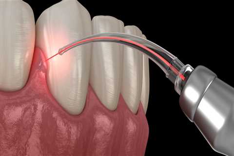 What Type of Laser is Used for Dental Cleaning?