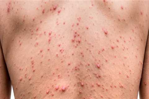 Antiviral Drugs: Exploring Treatments for Zoster Herpes