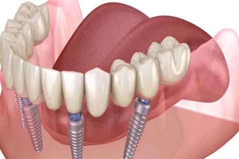 Can All-on-Four Dental Implants Be Whitened?