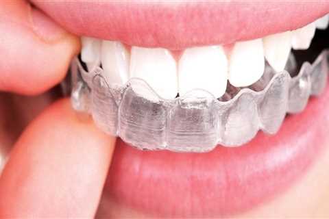 Do I Need to Wear a Retainer After Getting Invisalign Clear Braces?