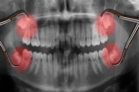Why Experts Now Advise Against Removing Wisdom Teeth