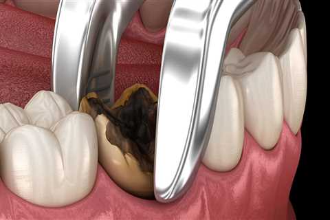 What to Expect After Wisdom Teeth Removal