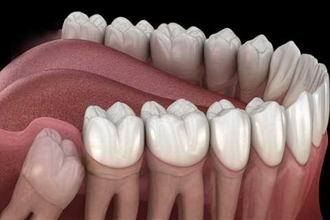 What You Should Know Before Wisdom Teeth Surgery