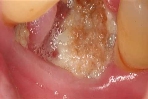 Can I Get an Infection from a Tooth Extraction?