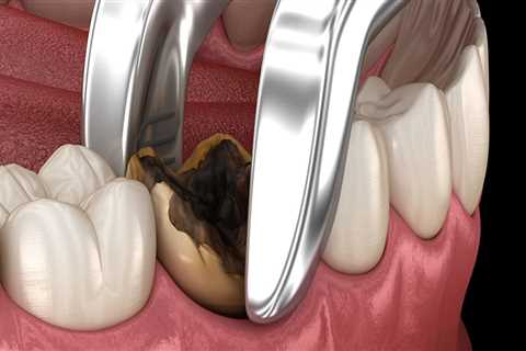 How Long Does It Take to Perform a Tooth Extraction?