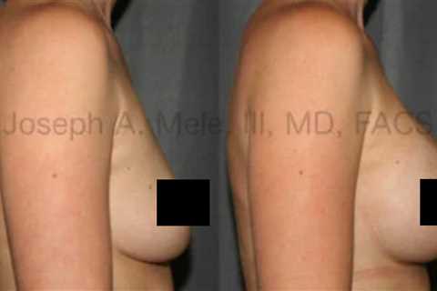 Surgery to Enhance the Breasts