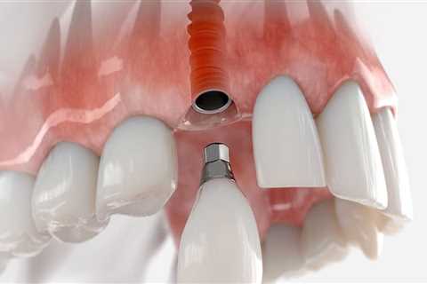 Understanding The Importance Of Dental X-Rays Before Getting A Dental Implant In Georgetown