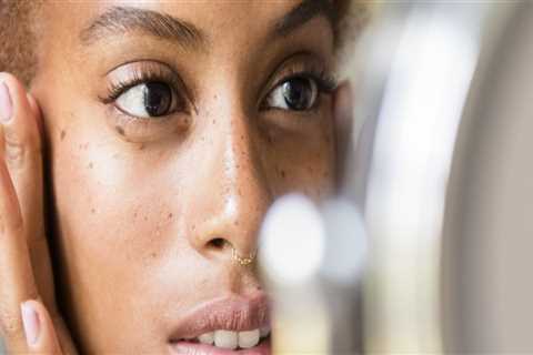 Acne Treatments: A Comprehensive Overview
