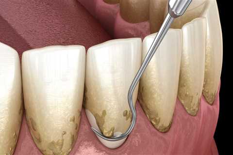 Is Deep Cleaning Worth It for Dental Health?