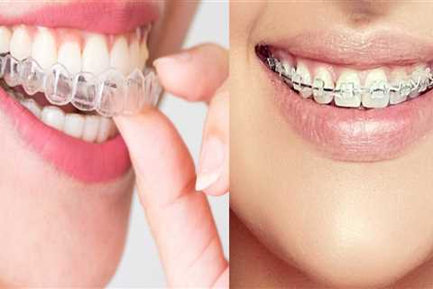 Are Clear Aligners Noticeable? An Expert's Perspective