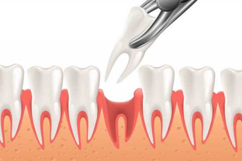 How Tooth Extractions can Save You Time, Stress, and Money.